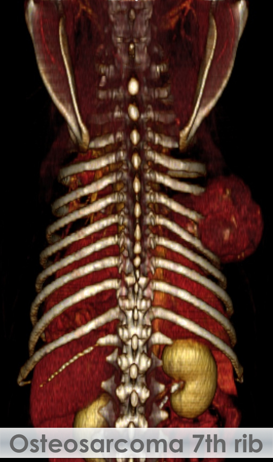 3D VR Image-dorsal-Rib-OSA