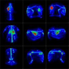 Bone Scintigraphy