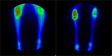 Bone Scintigraphy