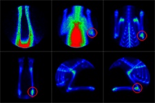 Bone Scintigraphy