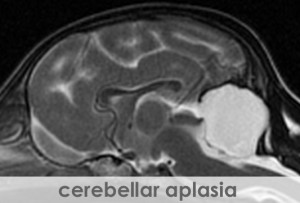 MRI-CerebellarAplasia