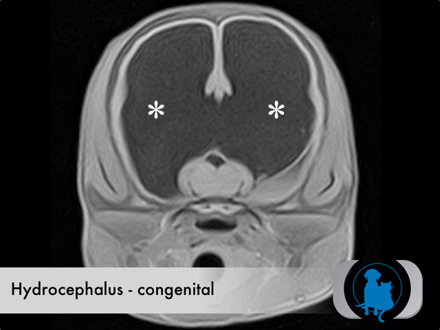 Hydrocephalus congenital