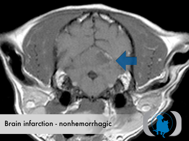 Brain infarction nonhemorrhagic