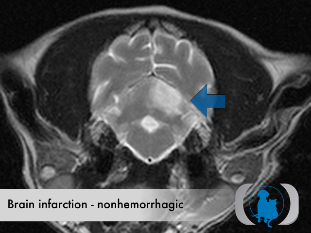 Brain infarction nonhemorrhagic