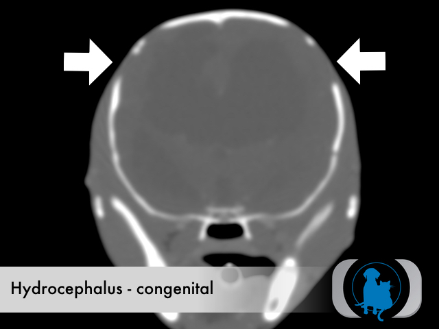 Hydrocephalus congenital
