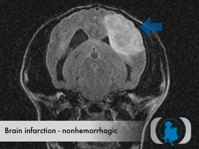 Brain infarction nonhemorrhagic