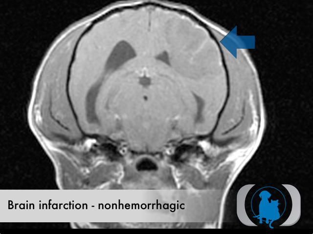 Brain infarction nonhemorrhagic