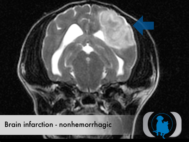 Brain infarction nonhemorrhagic
