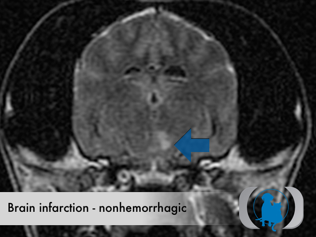 Brain infarction nonhemorrhagic