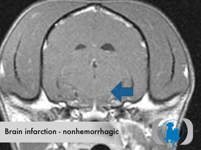 Brain infarction nonhemorrhagic
