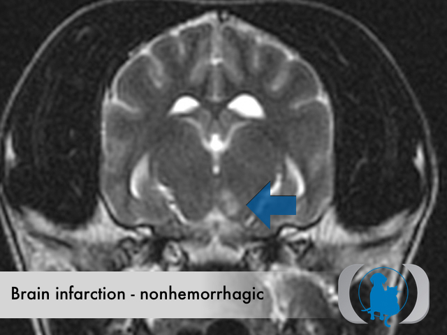 Brain infarction nonhemorrhagic