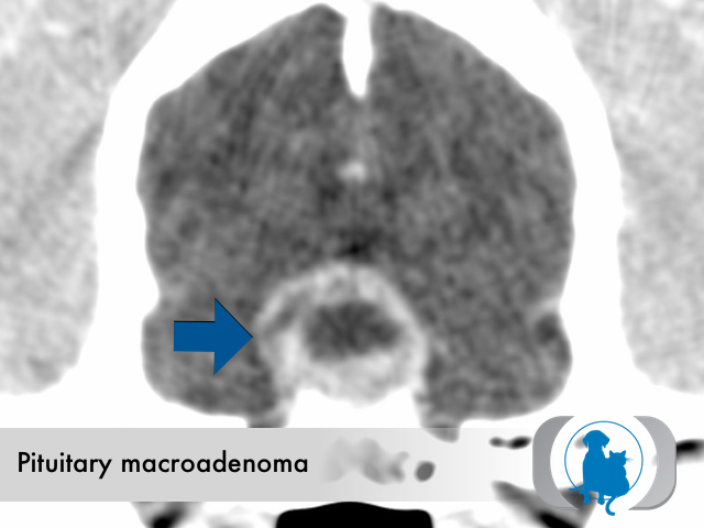 Pituitary macroadenoma