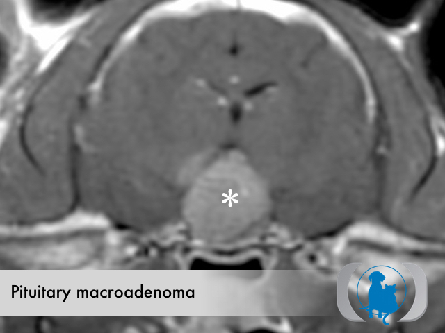 Pituitary adenoma