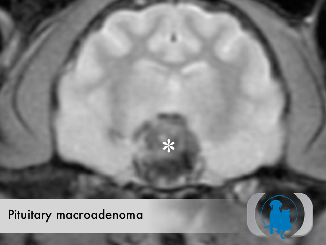 Pituitary macroadenoma