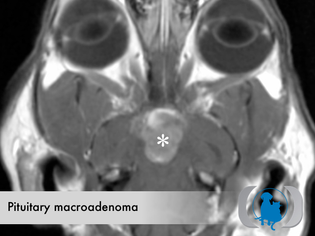 Pituitary macroadenoma