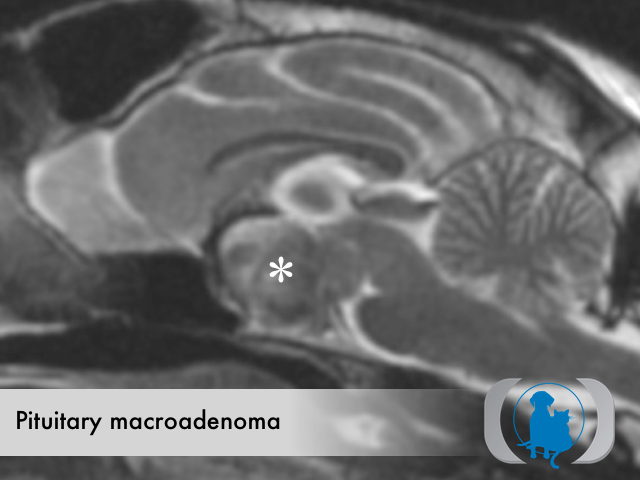 Pituitary Macroadenoma