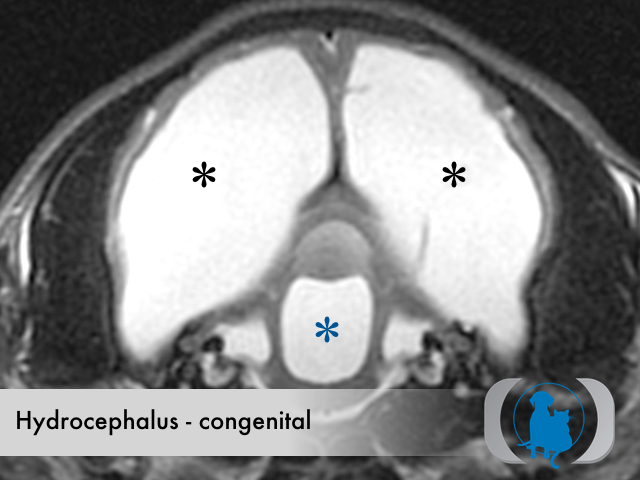 Hydrocephalus congenital
