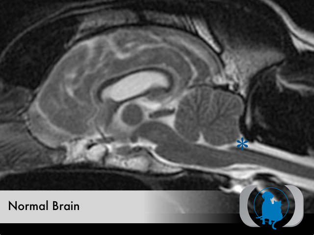 Caudal Occipital Malformation Syndrome