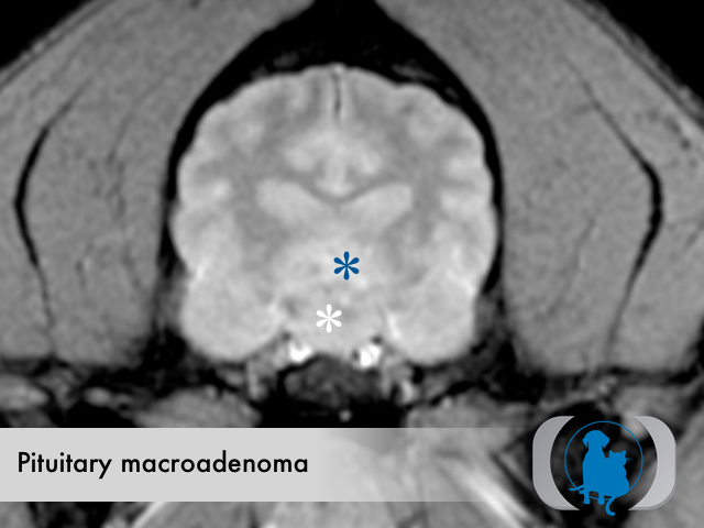 Pituitary macroadenoma