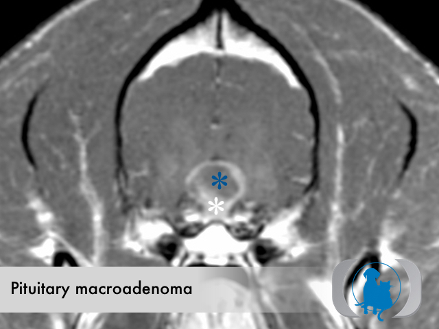 Pituitary macroadenoma