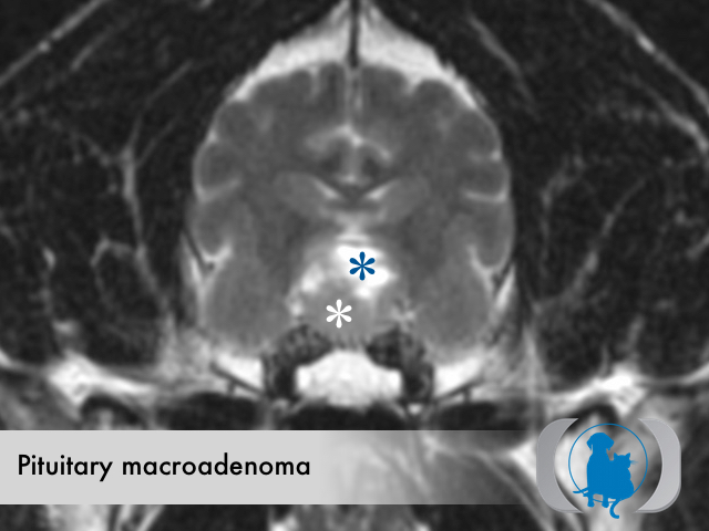 Pituitary adenoma