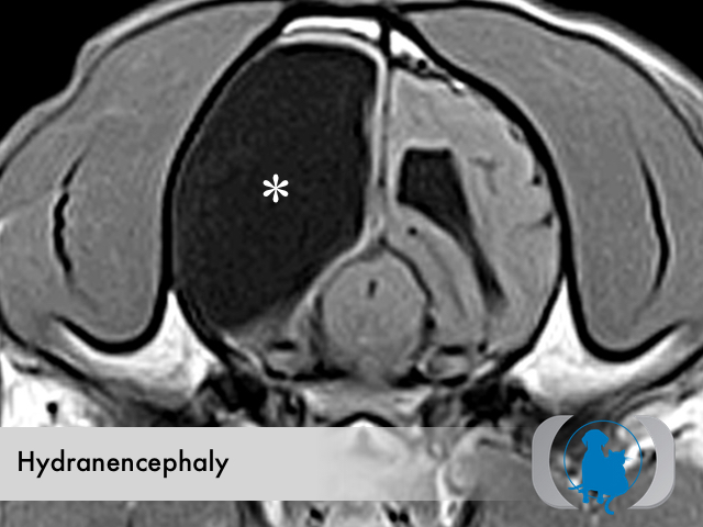 Congenital Hydranencephaly