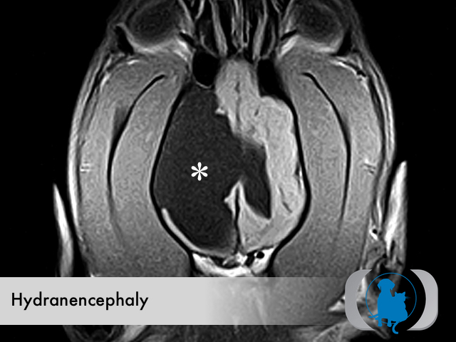 Congenital Hydranencephaly