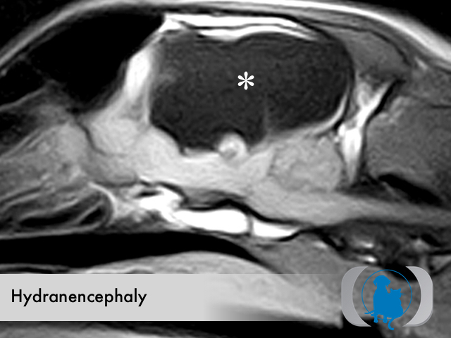 Congenital Hydranencephaly