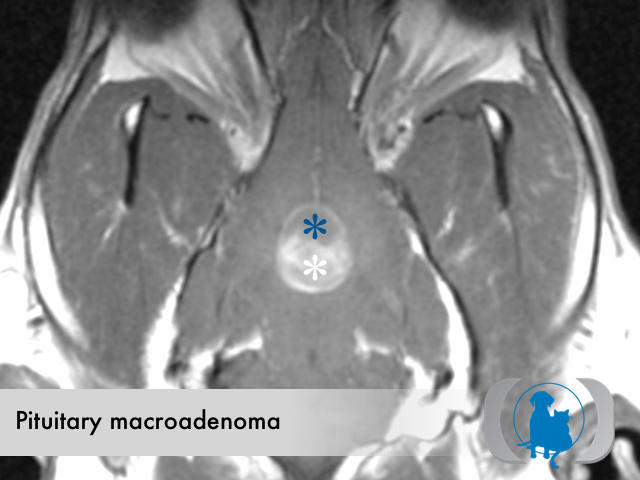 Pituitary macroadenoma