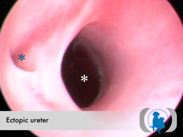 Ectopic ureter