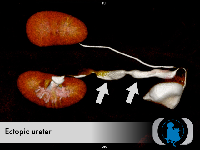 Ectopic ureter