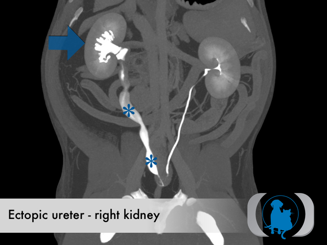 Ectopic ureter