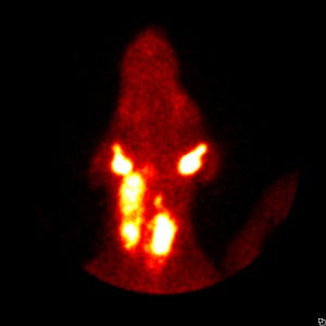 Figure 8. Thyroid scan in a dog with thyroid carcinoma involving both thyroid lobes with extensive regional metastasis. 