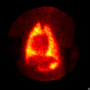 Figure 9. Ventral thorax (chest) image from a thyroid scan of a dog with diffuse pulmonary metastasis throughout both lungs. 