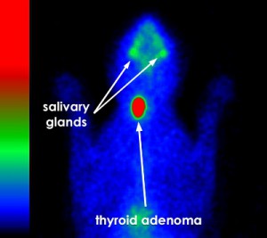 thyroid scintigraphy hyperthyroid cat unilateral adenoma