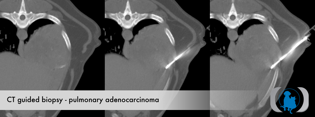3 Slice CT guided biopsy