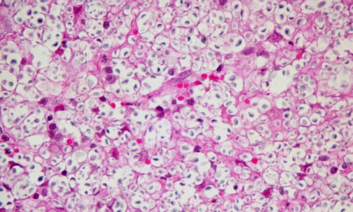 Cryptococcus Histopathology