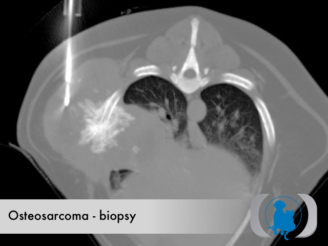 CT guided biopsy of osteosarcoma originating from the 7th rib on the right.
