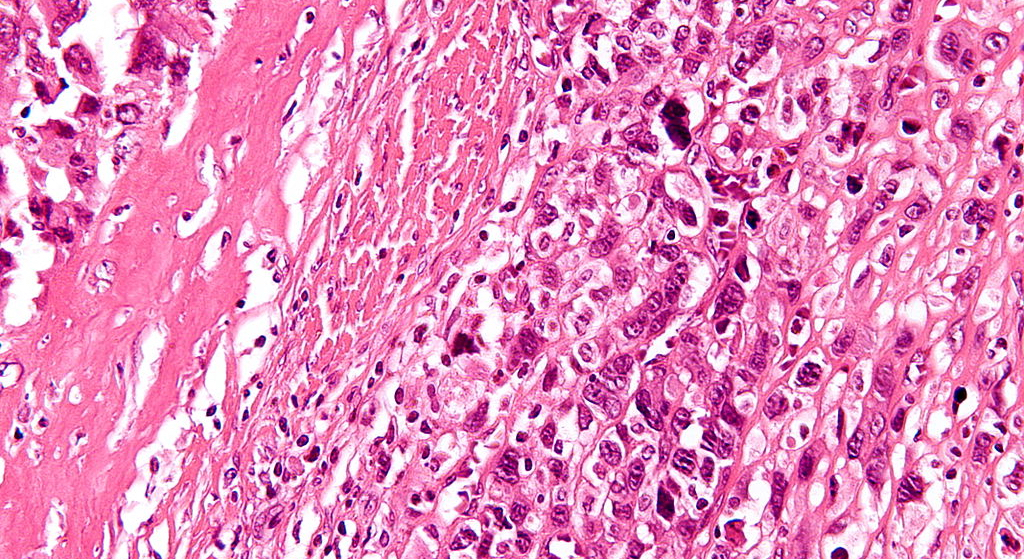 Osteosarcoma