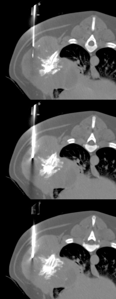biopsy thorax icd 9