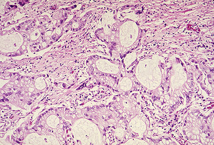 bronchogenic carcinoma