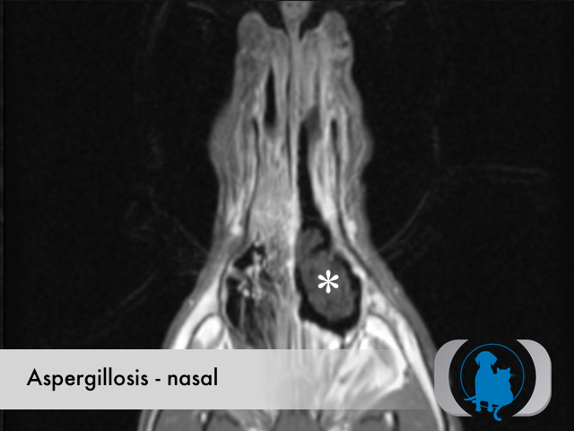 Aspergillosis nasal - MRI