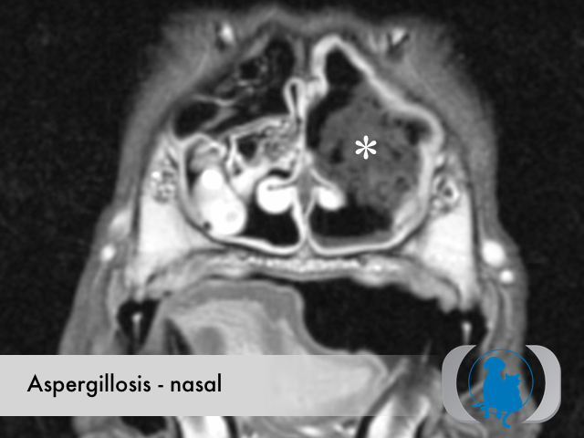 Aspergillosis nasal - MRI