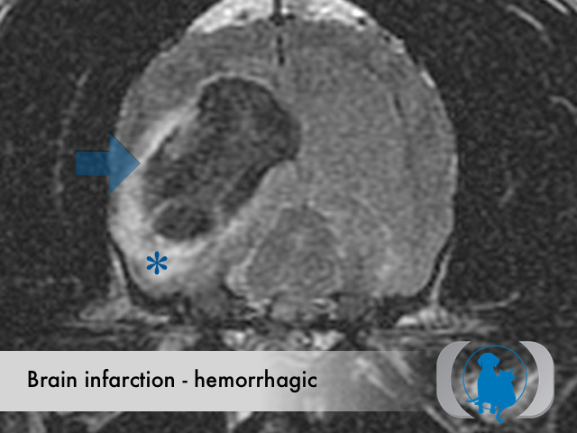 Brain infarction hemorrhagic