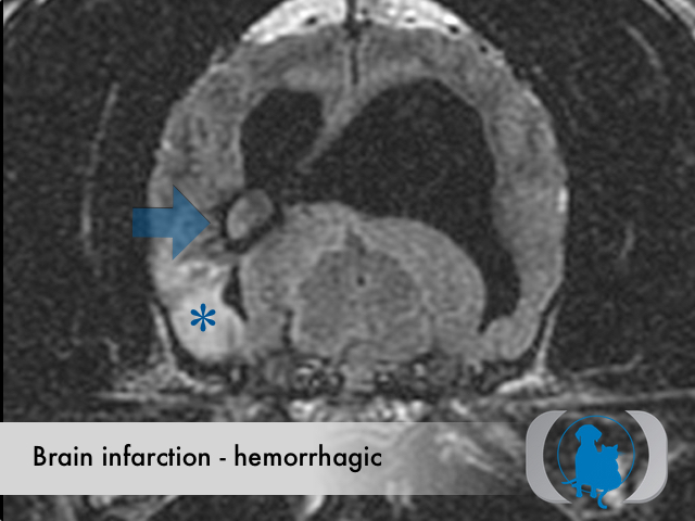 Brain infarction hemorrhagic