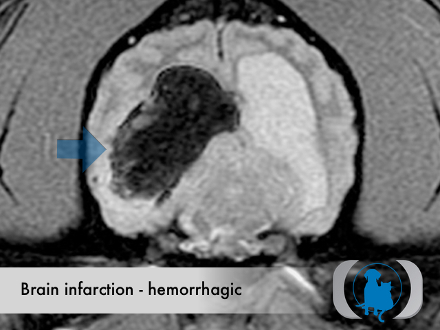 Brain infarction hemorrhagic