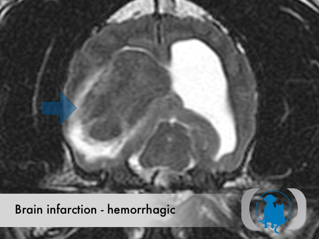 Brain infarction hemorrhagic