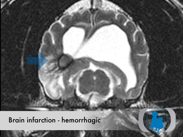 Brain infarction hemorrhagic