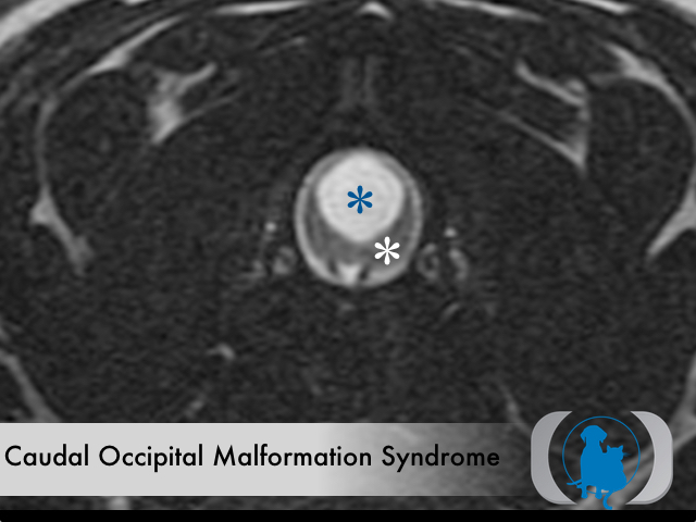 Caudal Occipital Malformation Syndrome