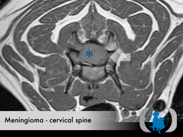 Meningioma spinal